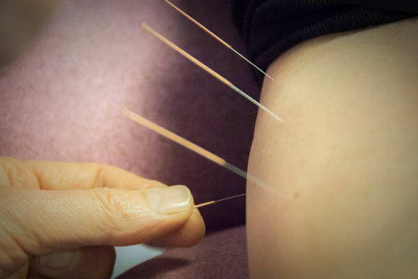 acupuncture lifting paris