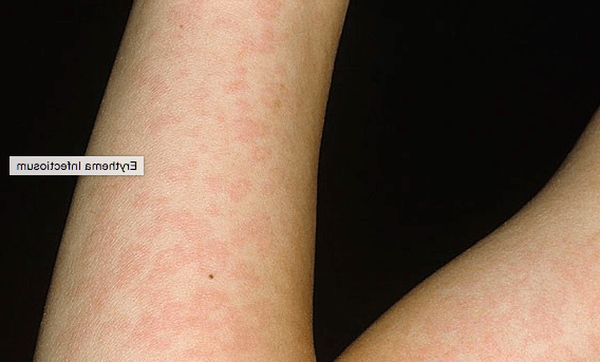 comment prevenir l acné