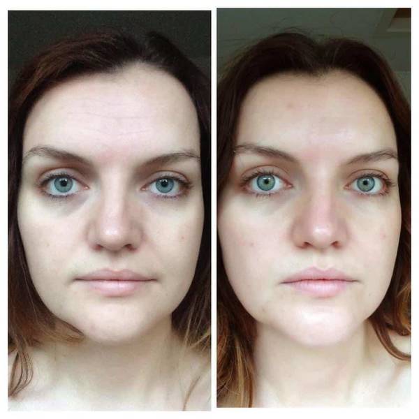 masque acné maison qui marche