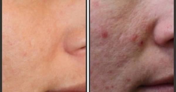 comment se débarrasser des taches d acné