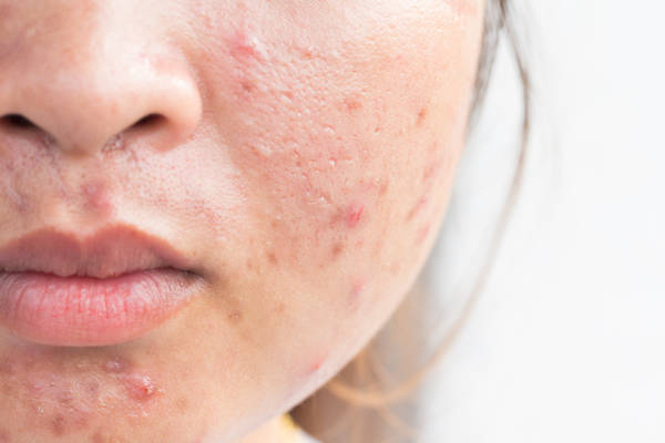 acné argile verte ou blanche