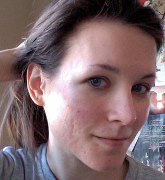 acné bactérie ou virus