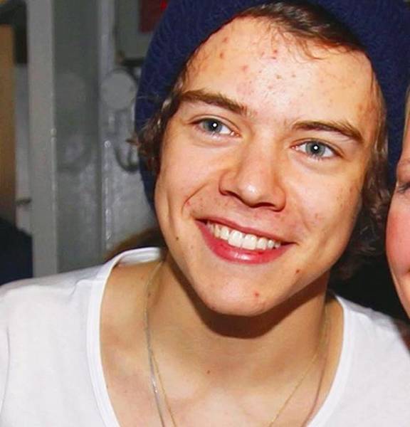 quelle pilule pour l acné