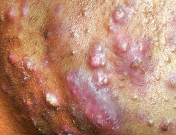 comment enlever bouton acné