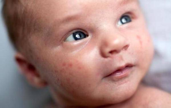 comment cacher les cicatrices d acné