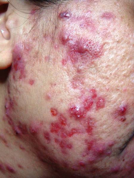 comment assécher bouton acné