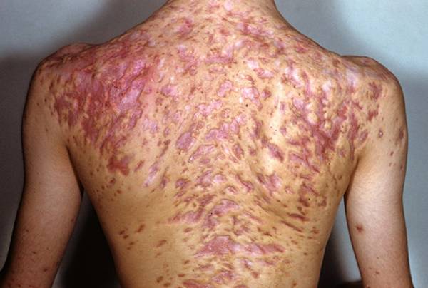 comment soigner l acne du chat