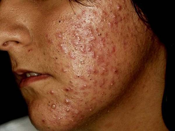 comment guérir l acné naturellement