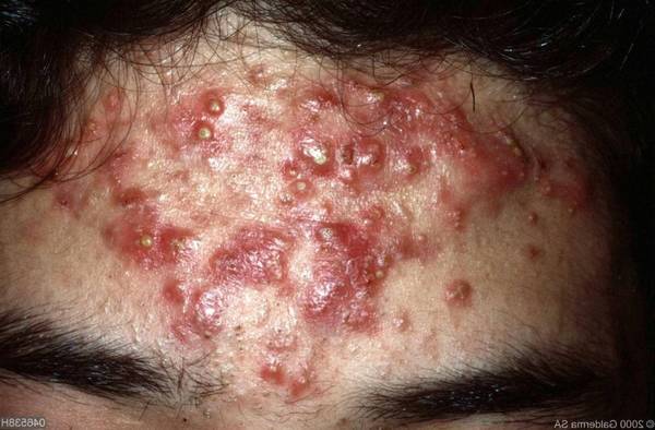 comment faire partir bouton acné