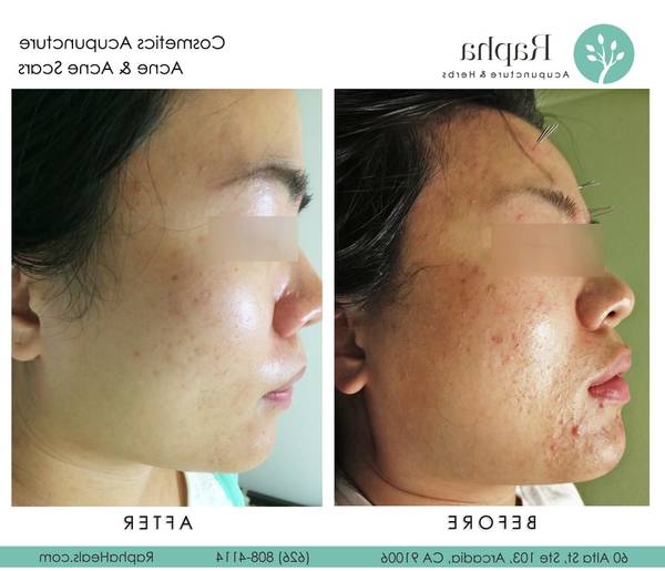 acne dans le dos fille ou garcon