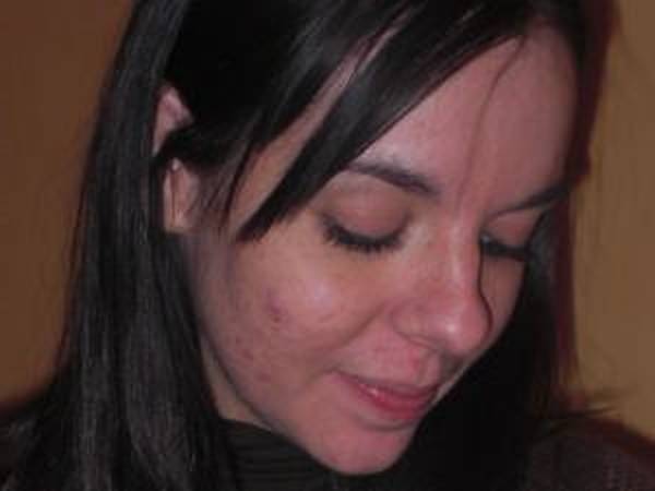 acné du nourrisson peau qui pèle