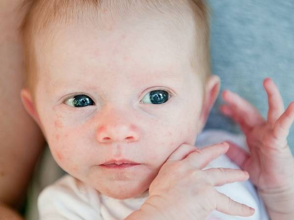 acné qui revient après roaccutane