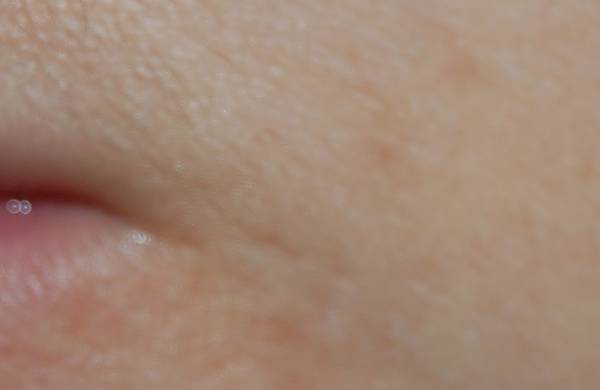 acne eau froide ou chaude