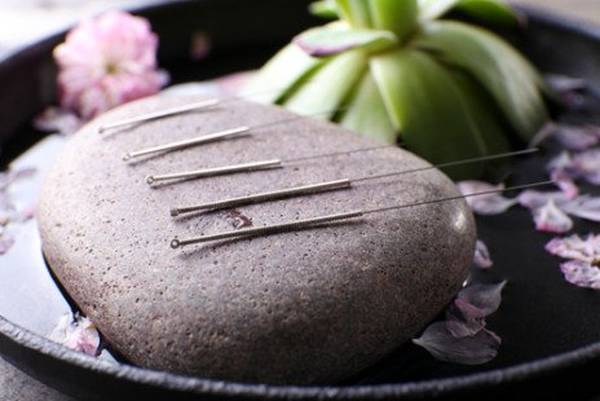 acupuncture paris 20