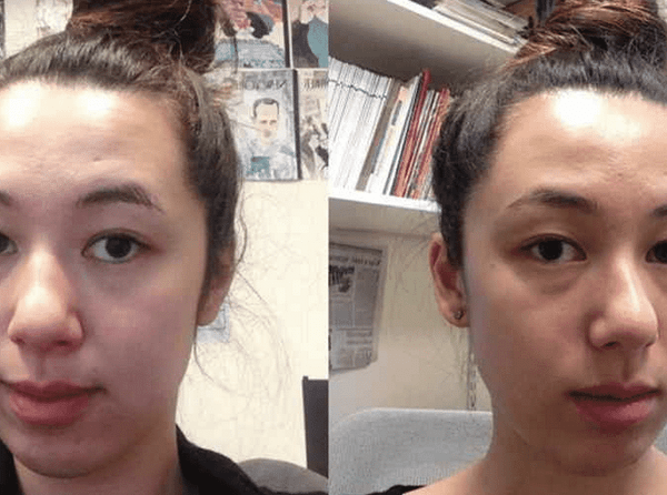 bardane acné combien de temps