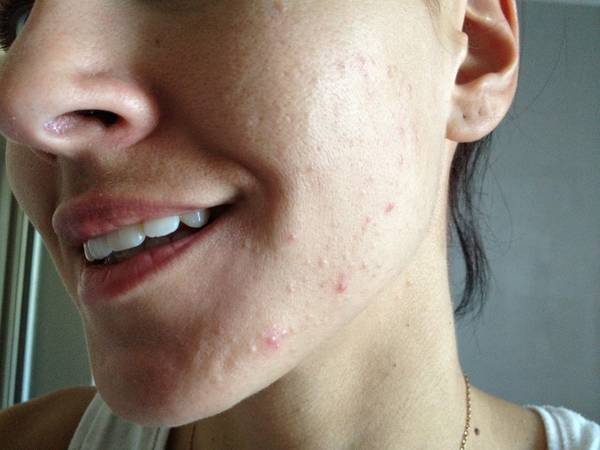 peau seche qui pele acné psoriasis