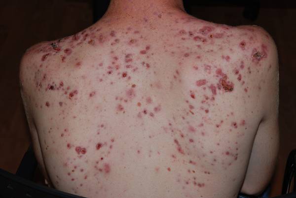 herpes labial ou acné