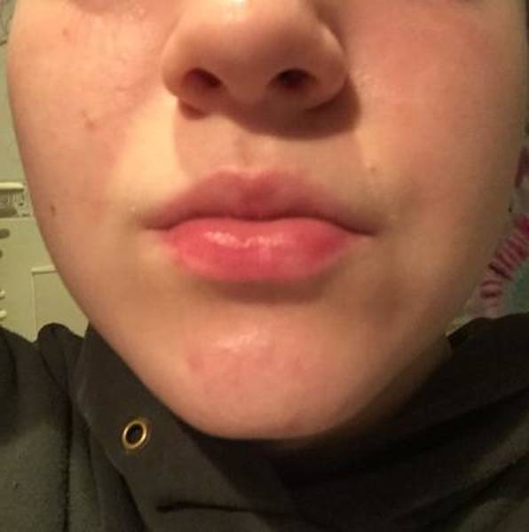 comment faire partir les boutons d acné rapidement et naturellement