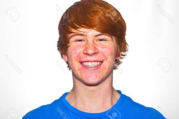 comment enlever son acné