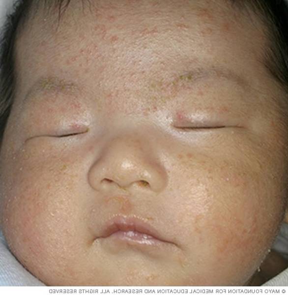 acné et soleil comment faire