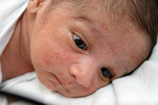 bouton acne qui reste