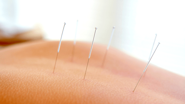 acupuncture yeux secs