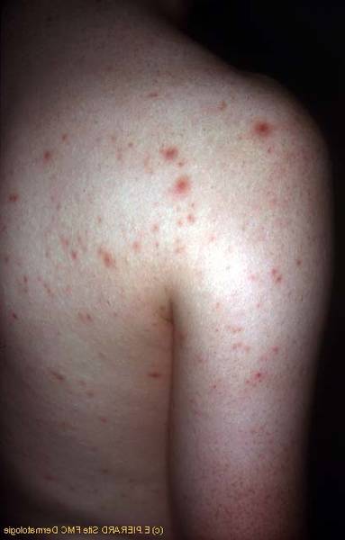 comment utiliser chlorure de magnésium acné