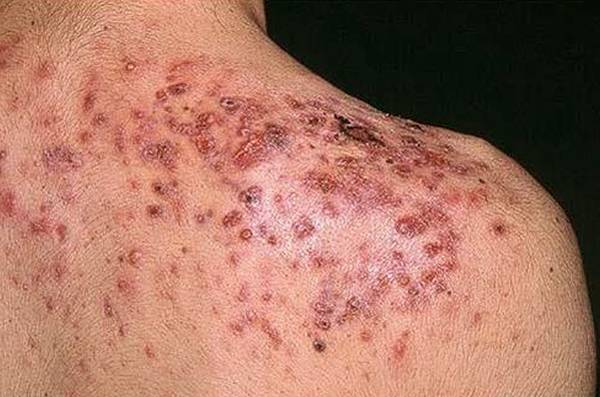 ou trouver miel de manuka acné