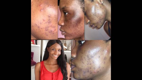 comment ne plus avoir d’acné