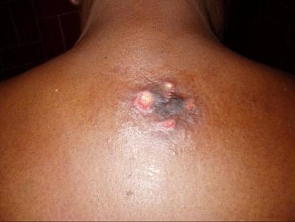 comment enlever les cicatrices d acné