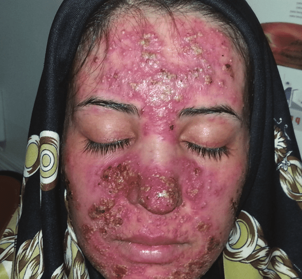 comment ne plus avoir des boutons d acné