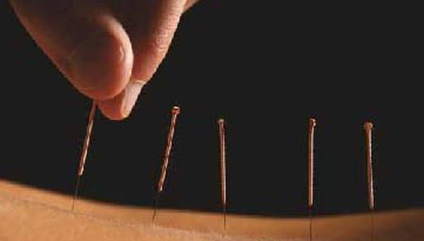 acupuncture paris 16