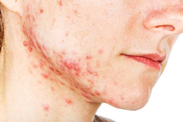 comment accepter son acne