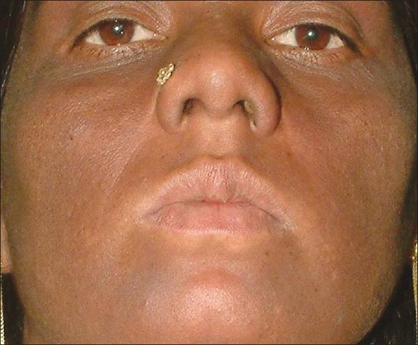 quelle huile pour acné