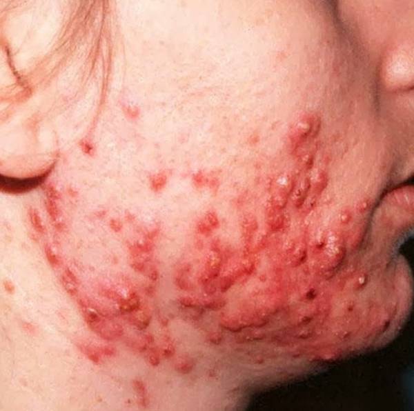 pourquoi acne sur le front