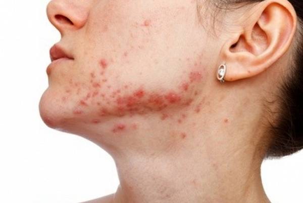 bardane acné combien de temps