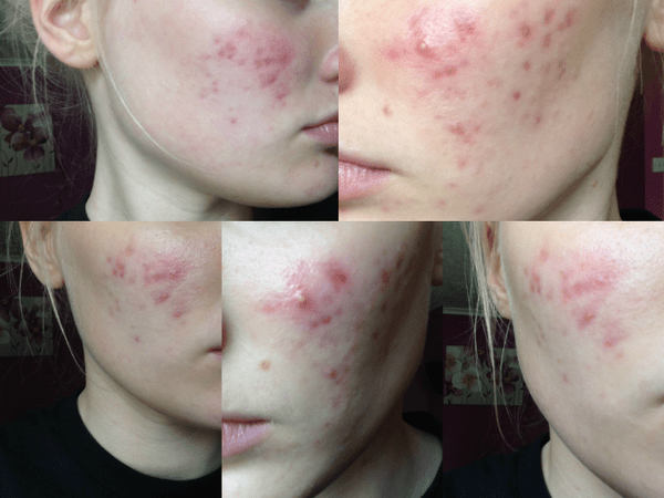 comment éviter l acné naturellement