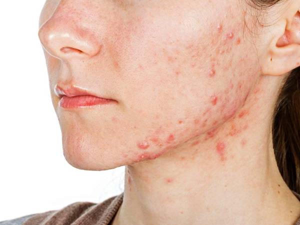 quelle lavande acné