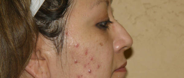 acné comment ça marche