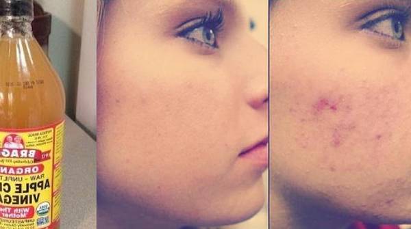 visage qui pèle acné