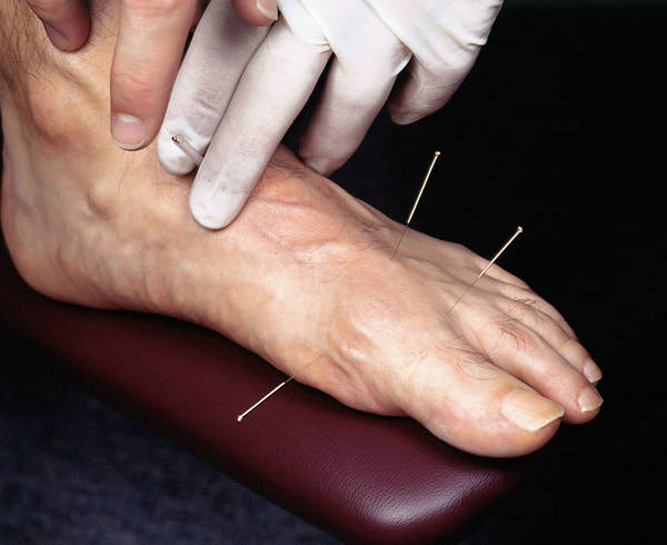 acupuncture jambes gonflées