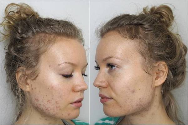 acne comment s'en débarrasser