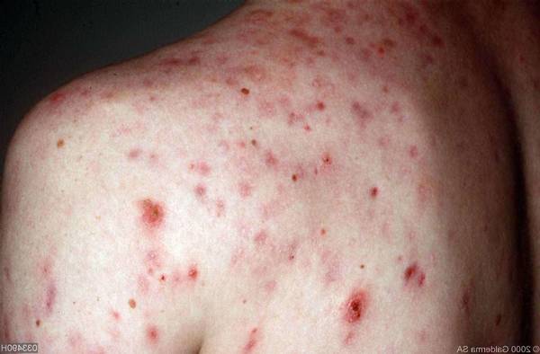 acne avant ou apres ovulation