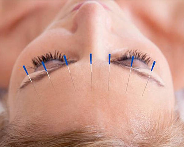 acupuncture maisons alfort