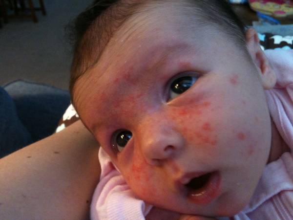 comment oublier son acné