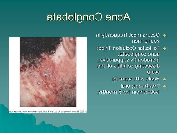 cicatrice acné laser ou peeling