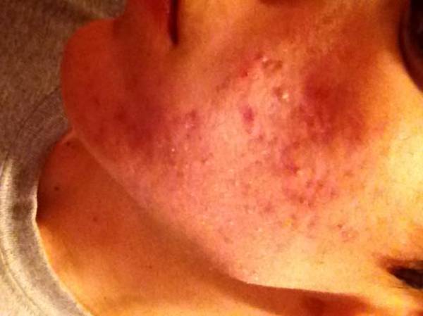 acne comment soigner naturellement