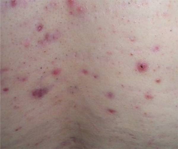 comment soigner l’acné