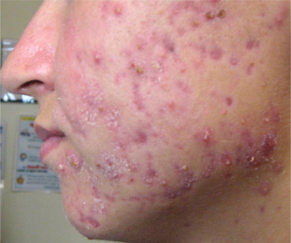 comment enlever les cicatrices acné