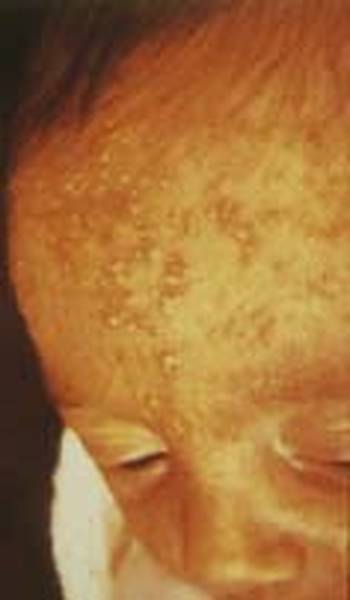 comment enlever l acné dans le dos